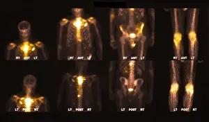 Disorders Prints: Bone scan showing multiple metastases
