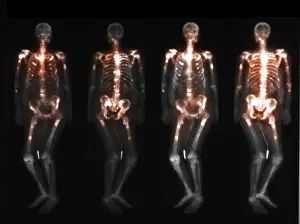 Disorders Prints: Bone scan showing multiple metastases