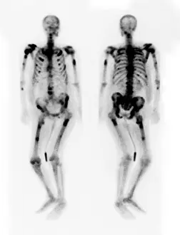 Cancer Prints: Bone scan showing multiple metastases
