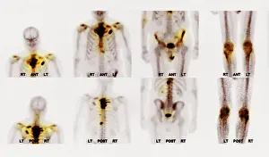 Cancer Prints: Bone scan showing multiple metastases