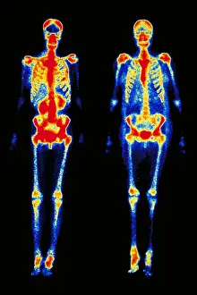 Scan Prints: Bone scans