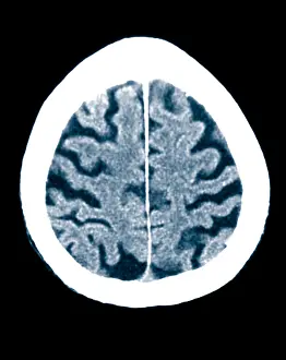 Patient Prints: Brain of Alzheimer's Patient, CT Scan