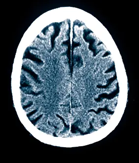 Patient Prints: Brain of Alzheimer's Patient, CT Scan