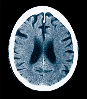 Diagnosis Prints: Brain of Alzheimer's Patient, CT Scan
