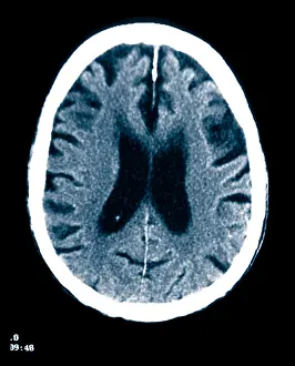 Diagnosis Prints: Brain of Alzheimer's Patient, CT Scan