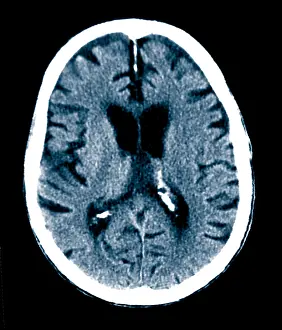 Diagnosis Prints: Brain of Alzheimer's Patient, CT Scan