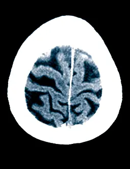 Diagnosis Prints: Brain of Alzheimer's Patient, CT Scan