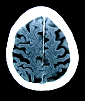 Diagnosis Prints: Brain of Alzheimer's Patient, CT Scan
