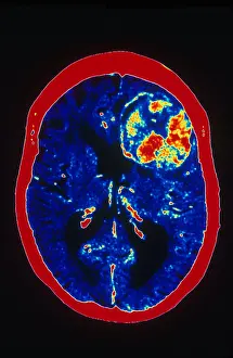 Malignancies Prints: Brain Cancer, CT Scan