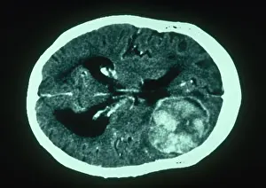 Malignancies Prints: Brain Cancer, CT Scan