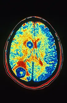 Tumor Prints: Brain Cancer, CT Scan