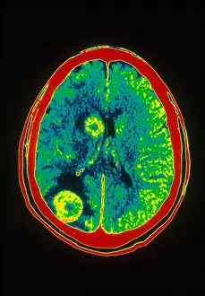 Tumor Prints: Brain Cancer, CT Scan