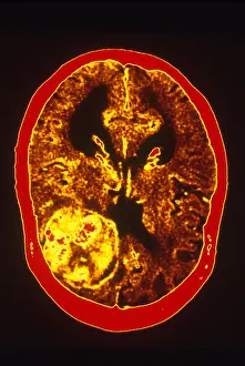 Tumor Prints: Brain Cancer, CT Scan