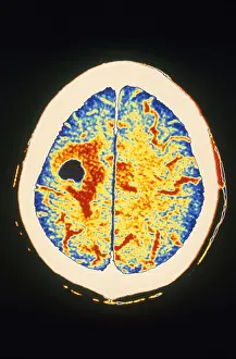 Malignancies Prints: Brain Cancer & Edema, CT Scan