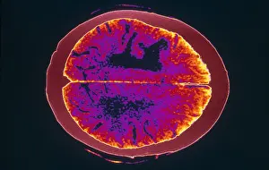 Tumor Prints: Brain Cancer & Edema, CT Scan