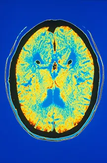 Medical Prints: Brain, CT Scan