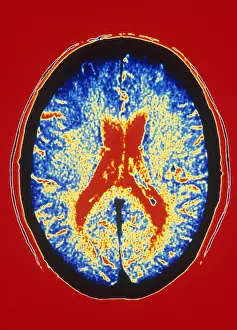 Ventricular Prints: Brain, CT Scan