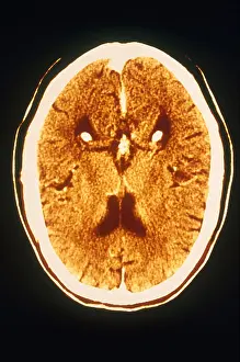 Ventricular Prints: Brain, CT Scan