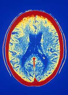 Brain Prints: Brain, CT Scan