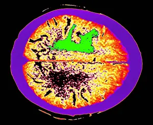 Computed Prints: Brain edema