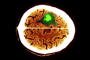 Computed Prints: Brain edema