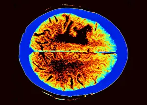 Tumor Prints: Brain edema