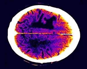 Tumor Prints: Brain edema