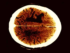 Tumor Prints: Brain edema