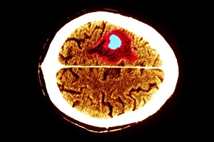 Tumor Prints: Brain edema