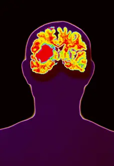 Brain Prints: Brain haemorrhage