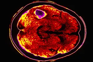 Hemorrhage Prints: Brain hemorrhage