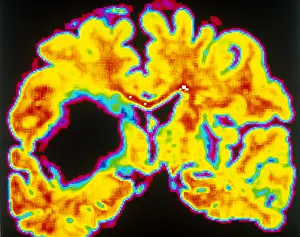 October Prints: Brain hemorrhage