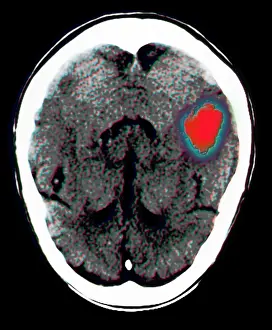 2003 Prints: Brain hemorrhage