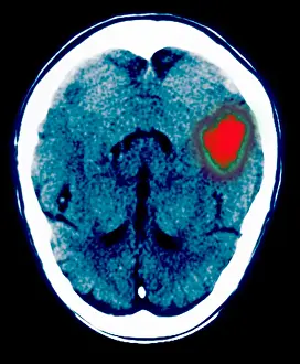 2003 Prints: Brain hemorrhage