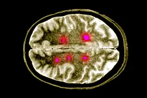 April Prints: Brain scan of MS