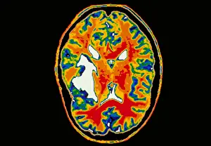 2000 Prints: Brain tumor