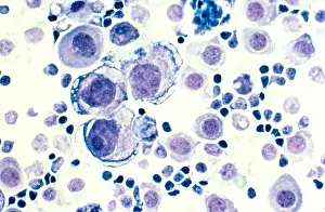 : Breast cancer under a microscope
