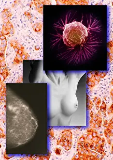 Electron Prints: Breast Cancer Montage