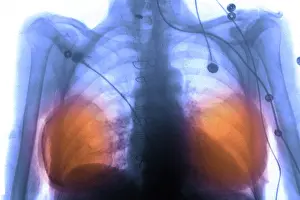 Diagnosis Prints: Breast Implants