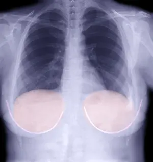Mixed Science Images Prints: Breast Implants