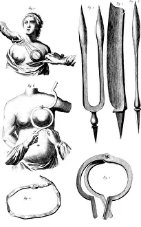 Knife Prints: Breast Surgery Instruments, 1772