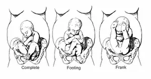 Science Source Collection Prints: Breech Birth Positions, Illustration