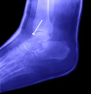 Radiographs Prints: Broken Ankle
