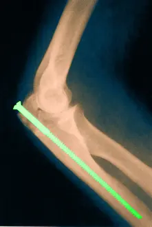 1980 Prints: Broken Arm with Metal Pin, X-Ray