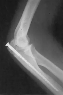 Technique Prints: Broken Arm with Metal Pin, X-Ray