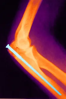 Technique Prints: Broken Arm with Metal Pin, X-Ray