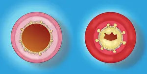 Tubes Prints: Bronchitis