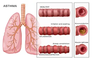 Condition Prints: Bronchoconstriction, Asthma