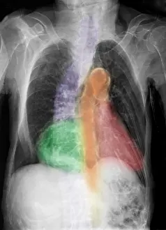 Body Prints: Calcification of Aorta, Scoliosis in 96 Year Old Woman