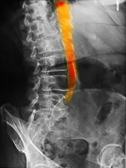 Enhancement Prints: Calcified Aorta